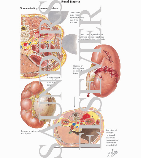 Watermarked preview of labeled image: Renal Trauma - Nonpenetrating Trauma of Kidney