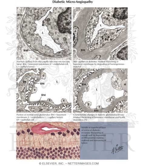 Microangiopathies
