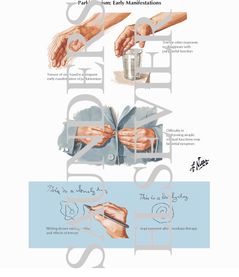 Watermarked preview of labeled image: Classification of Parkinsonism
