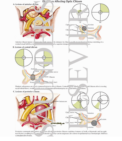 Watermarked preview of labeled image: Lesions of Anterior and Posterior Chiasm