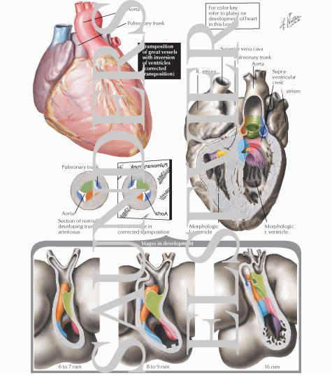 Watermarked preview of labeled image: Transposition of the Great Vessels with Inversion of the Ventricles (Corrected Transposition of the Great Vessels)