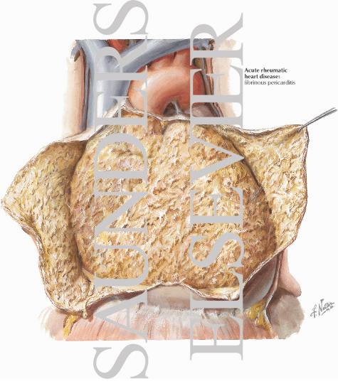 Watermarked preview of labeled image: Rheumatic Heart Disease I