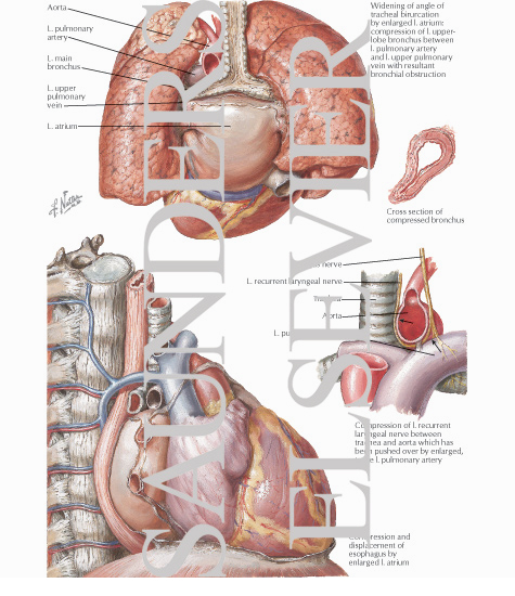 Rheumatic Heart Disease V - Mitral Stenosis:  Secondary Anatomic Effect