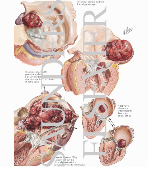 Rheumatic Heart Disease VII - Mitral Stenosis: Thromboembolic Complications