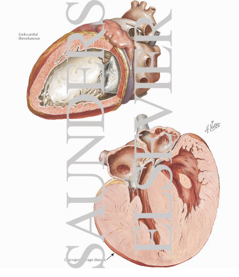 Endocardial Fibroelastosis and Glycogen Storage Disease