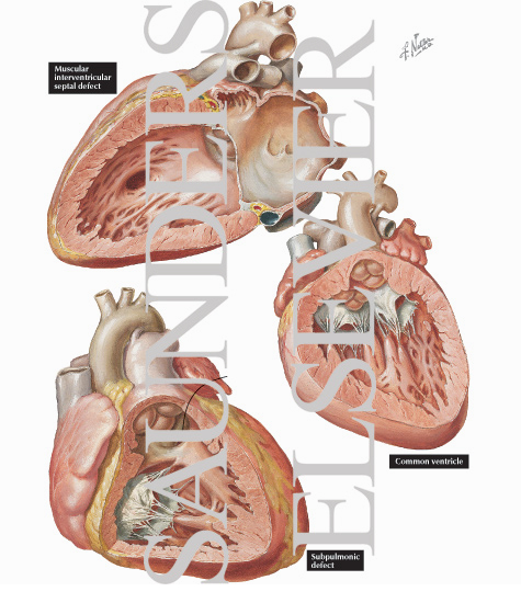 Watermarked preview of labeled image: Anomalies of the Ventricular Septum