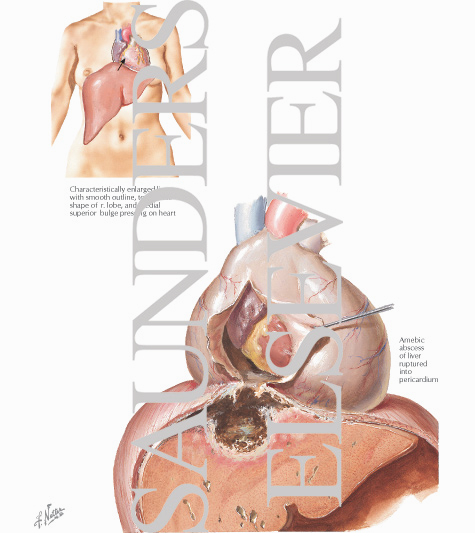 Watermarked preview of labeled image: Amebic Pericarditis