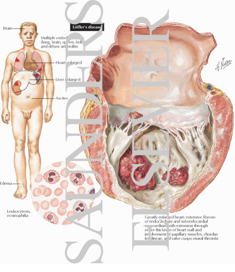 Watermarked preview of labeled image: Loffler's Disease