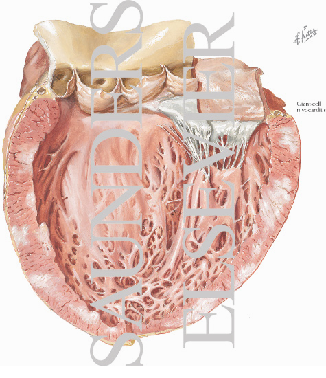Watermarked preview of labeled image: Idiopathic Myocarditis