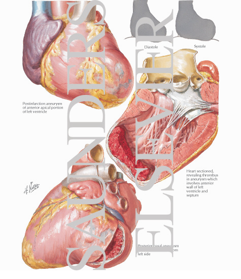Arteriosclerotic Heart Disease