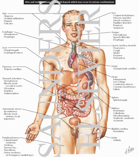 Watermarked preview of labeled image: Amyloid Deposit / Sites and Manifestations