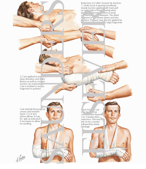 Traction Reduction Of Colles' Fracture