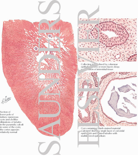 Sponge Kidney