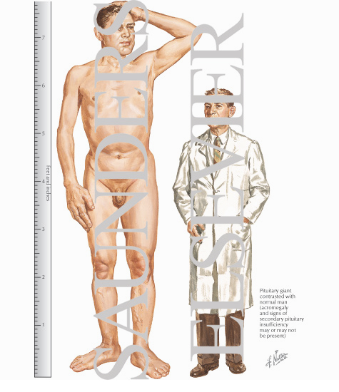 Gigantism