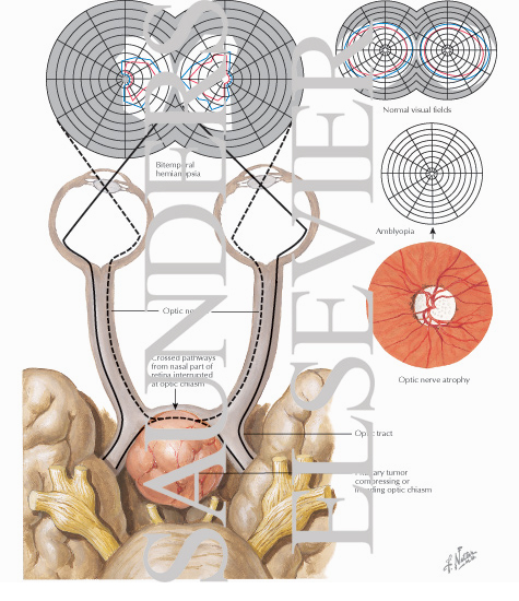 Pituitary Tumor: Visual Field Defect With Pituitary Tumor
