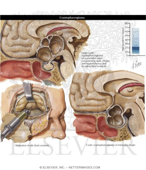 Craniopharyngioma