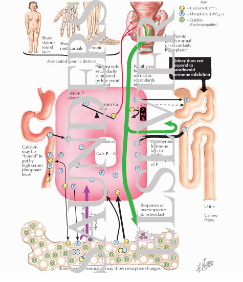 Watermarked preview of labeled image: Pathologic Physiology of Pseudohypoparathyroidsim