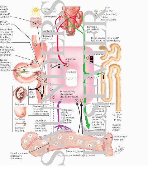 Watermarked preview of labeled image: Osteomalacia (Rickets) of Alimentary Origin