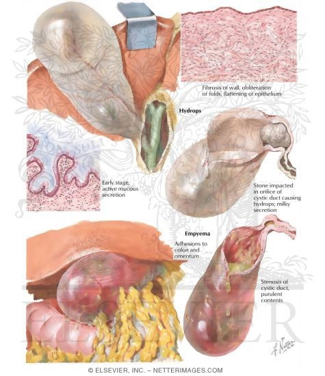 Hydrops and Empyema of Gallbladder