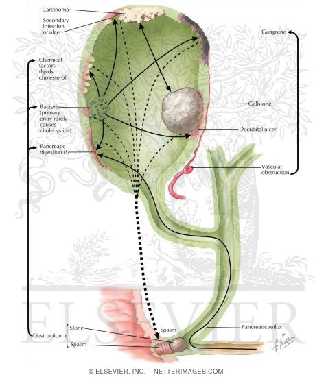 Watermarked preview of labeled image: Interrelation of Gallbladder Diseases