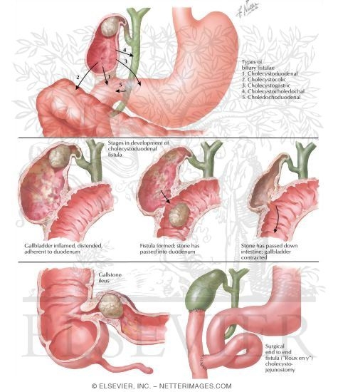 Bile Duct Fistulae