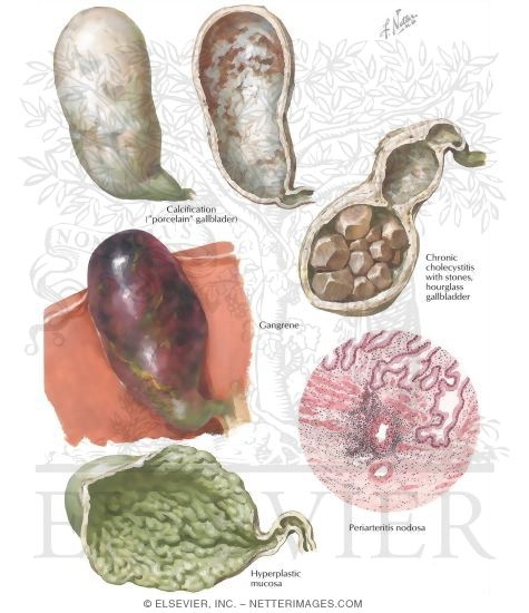 Cholecystitis II - Later Stages and Complications
