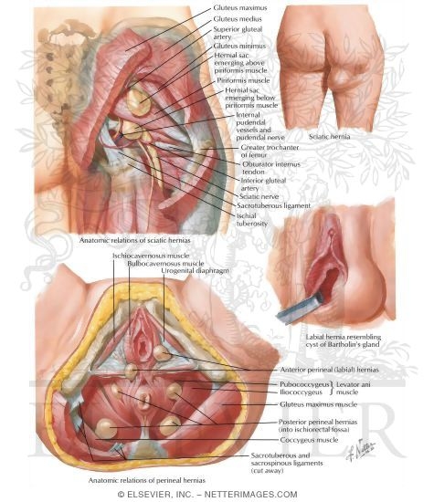 Hernia VI - Sciatic and Perineal Hernias