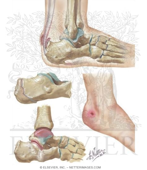 Disorders of Heel