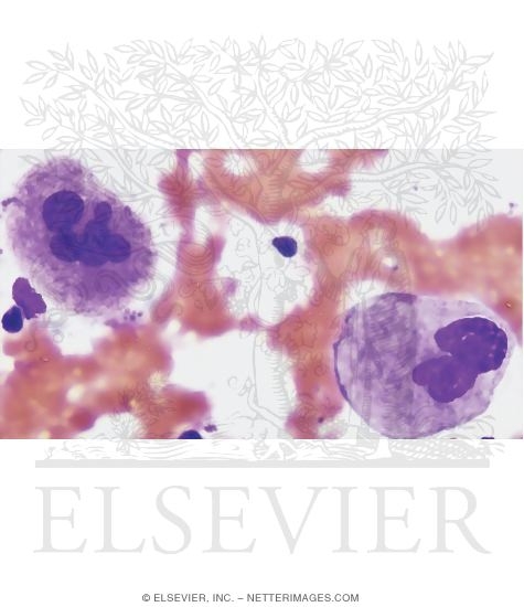 Light Micrograph of Megakaryocytes In a Bone Marrow Smear