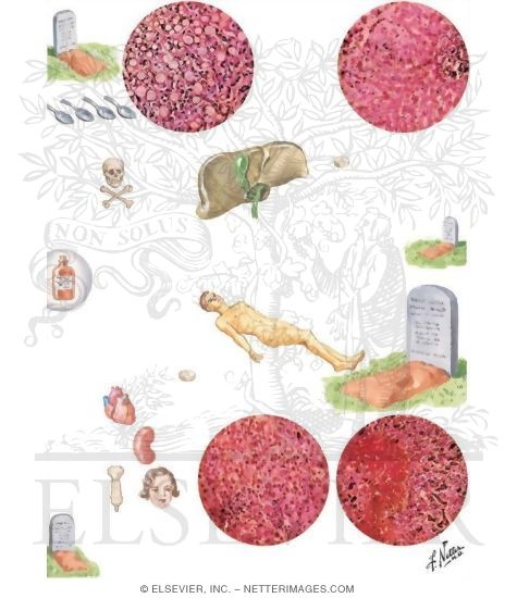 Watermarked preview of unlabeled image: Drug-Induced Hepatic Injuries