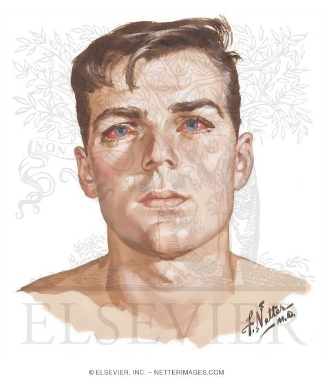 Watermarked preview of unlabeled image: Extravasation of Blood Into the Conjunctivae