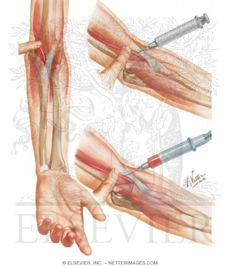 Technique of Arterial Puncture