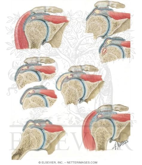 Natural History of Calcified Deposits In Rotator Cuff