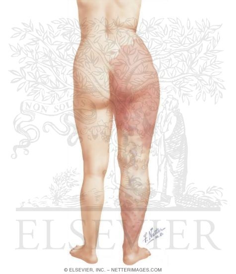 Varicose Veins Secondary to Arteriovenous Fistulas