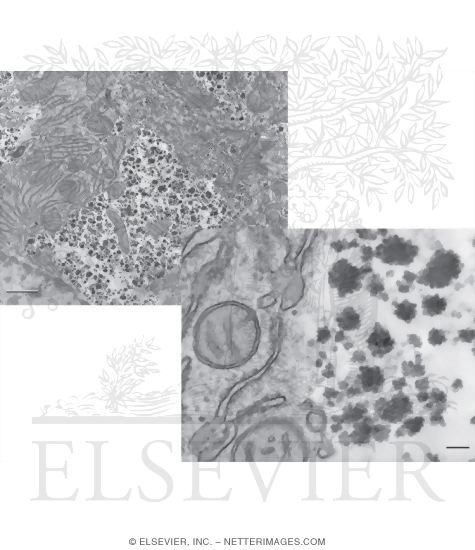 Electron Micrograph of Glycon In the Cytoplasm of a Hepatocyte