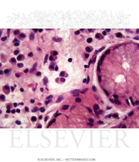 Watermarked preview of unlabeled image: Light Micrograph Showing Plasma Cells In Connective Tissue Underlying a Palatine 
Tonsil