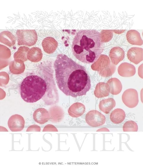 Bone Marrow Smear Showing a Plasma Cell
