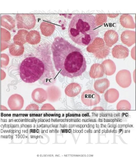 Bone Marrow Smear Showing a Plasma Cell