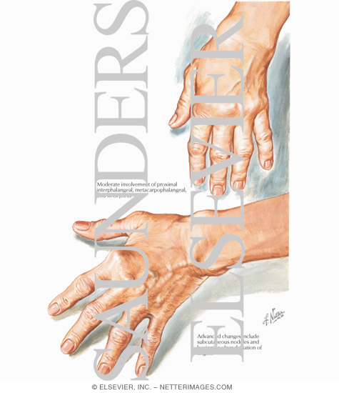 Watermarked preview of labeled image: Early and Moderate Hand Involvement In Rheumatoid Arthritis