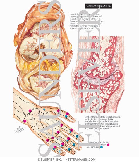 Pathology of Osteoarthritis and Joints Usually Involved