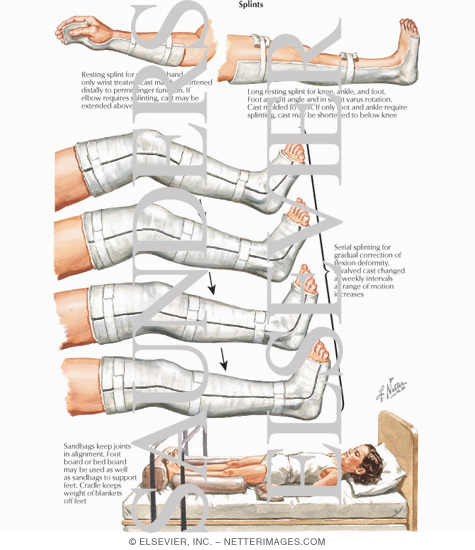 Watermarked preview of labeled image: Splints to Rest Inflamed Joints and Correct Deformities