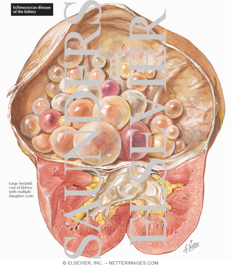 Watermarked preview of labeled image: Echinococcus Disease of the Kidney