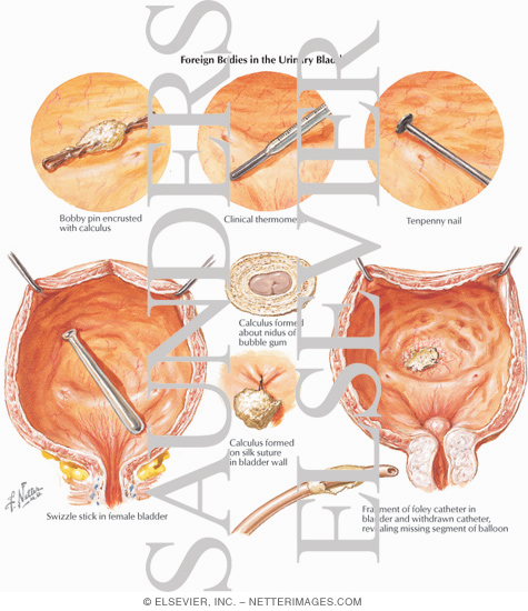 Watermarked preview of labeled image: Foreign Bodies in the Urinary Bladder