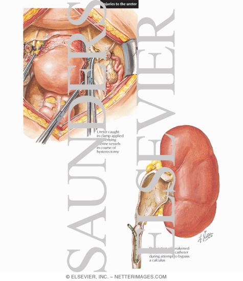 Watermarked preview of labeled image: Injuries to the Ureter