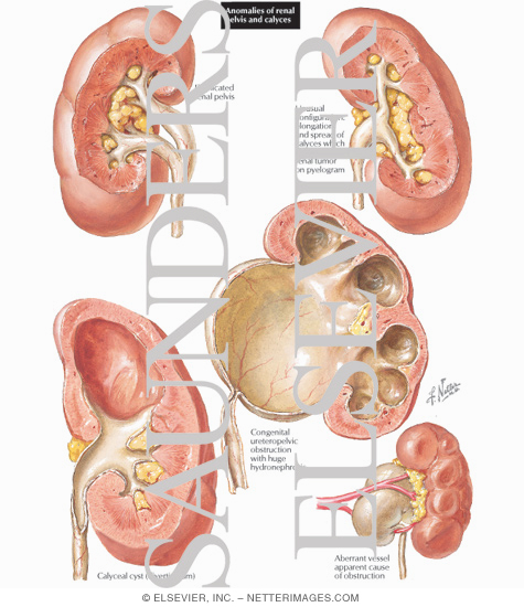 Watermarked preview of labeled image: Anomalies of Renal Pelvis and Calyces