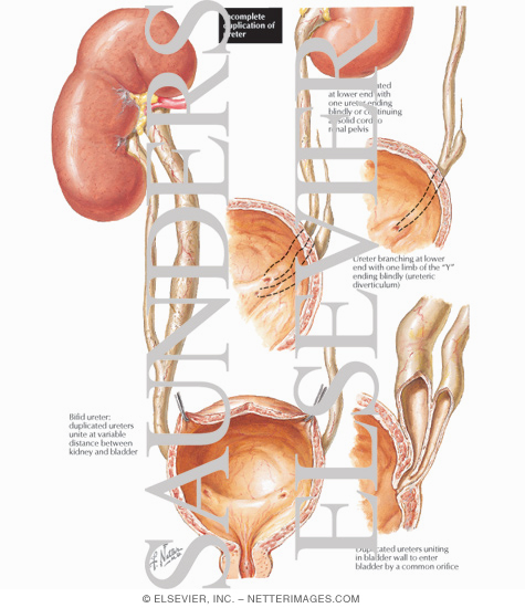 Watermarked preview of labeled image: Incomplete Duplication of Ureter