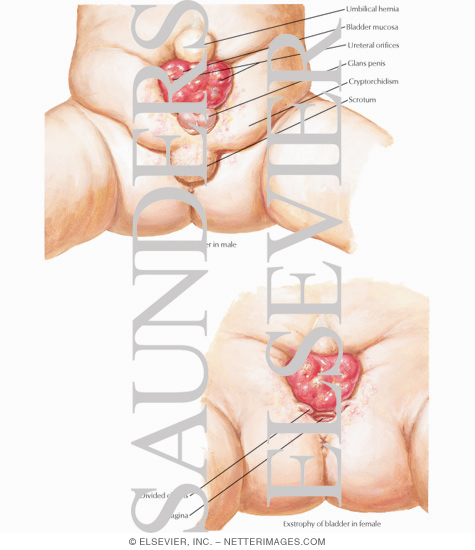 Exstrophy of the Bladder