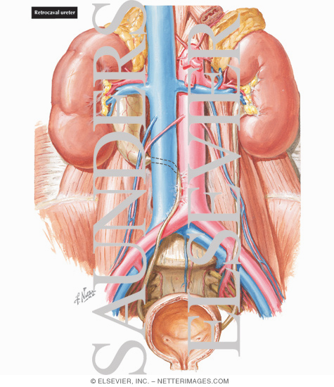 Retrocaval Ureter