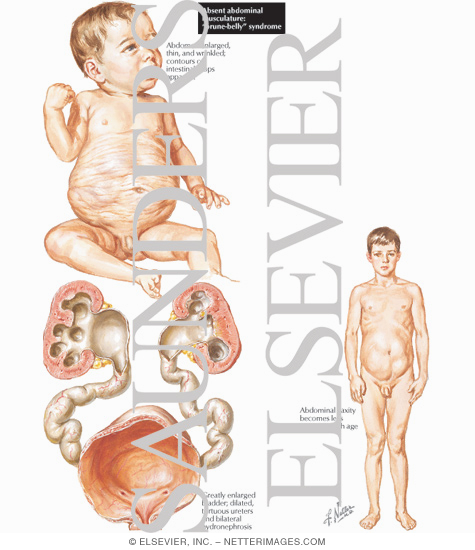 Absent Abdominal Musculature:
