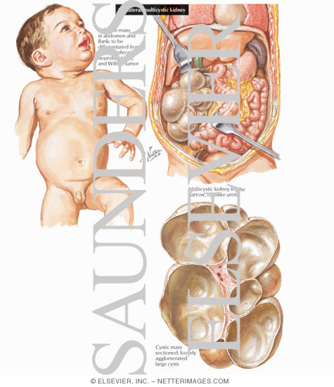 Watermarked preview of labeled image: Unilateral Multicystic Kidney